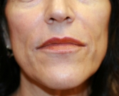 Feel Beautiful - Lip Lines Filler - After Photo